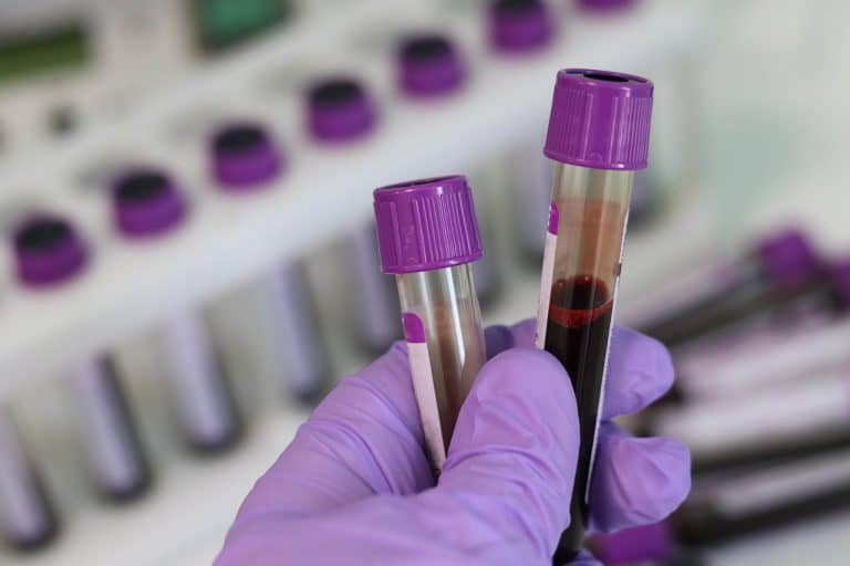 Le dépistage par prise de sang de la trisomie 21 est officiellement remboursé