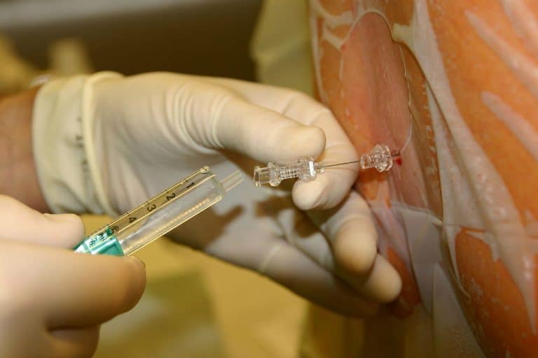 Rachianesthésie : tout sur l&rsquo;accouchement sans douleur
