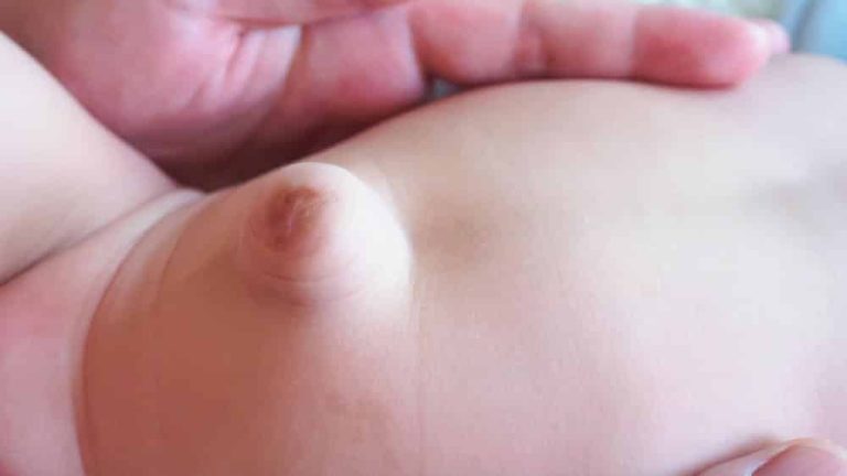 Hernie ombilicale de bébé : tout savoir dessus