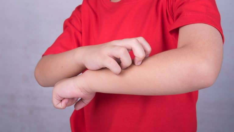 Les rougeurs sur la peau sont-elles un signe du Coronavirus ?